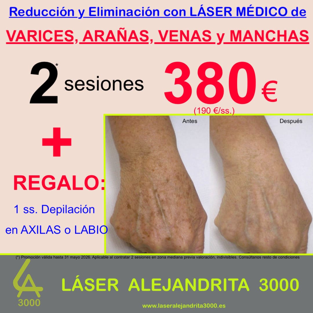 OFERTA en Eliminar de VARICES, ARAÑAS, VENAS y MANCHAS con LÁSER MÉDICO en TOLEDO