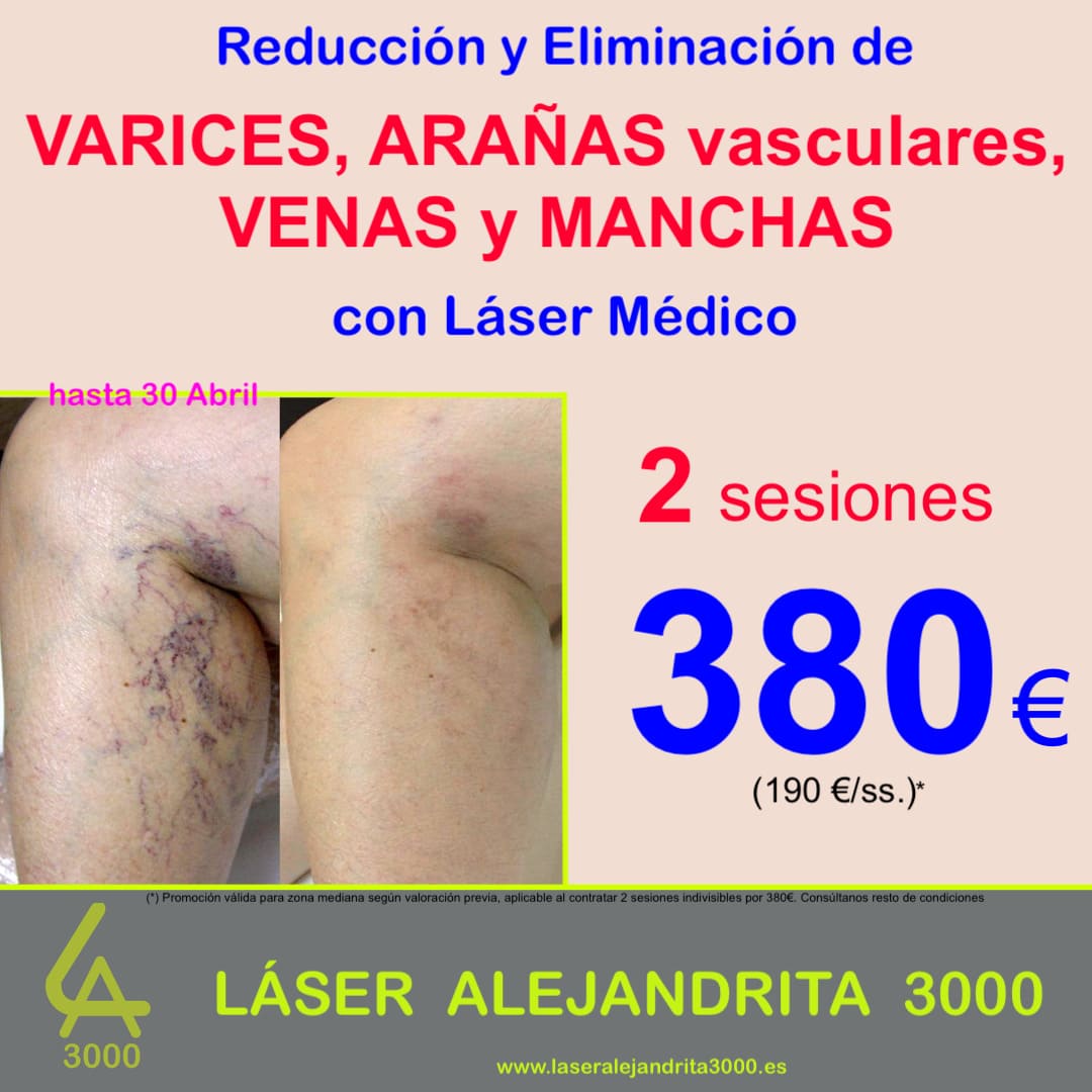 OFERTA en Eliminar de VARICES, ARAÑAS, VENAS y MANCHAS con LÁSER MÉDICO en TOLEDO