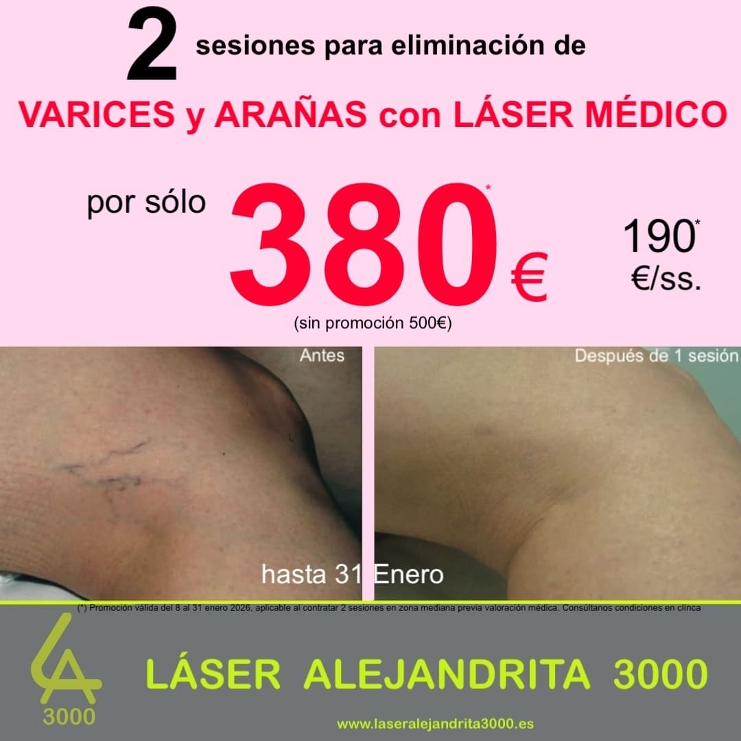 REBAJAS en Eliminación de VARICES y ARAÑAS VASCULARES en TOLEDO: