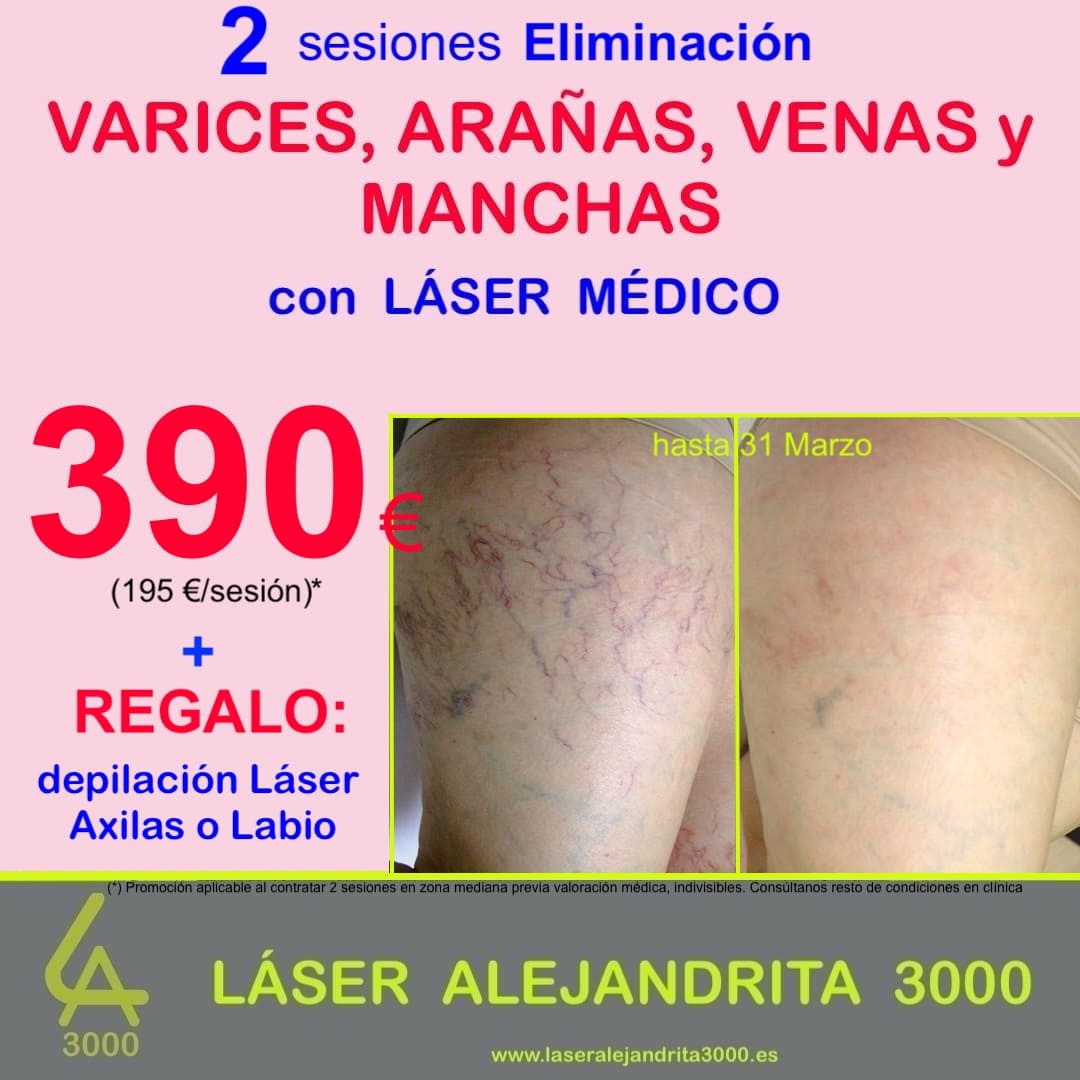OFERTA en Eliminar de VARICES, ARAÑAS, VENAS y MANCHAS con LÁSER MÉDICO en TOLEDO